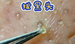 挤黑头视频,专业技巧与注意事项